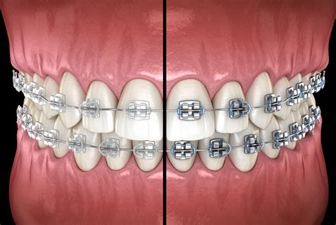 ceramic braces vs metal brackets